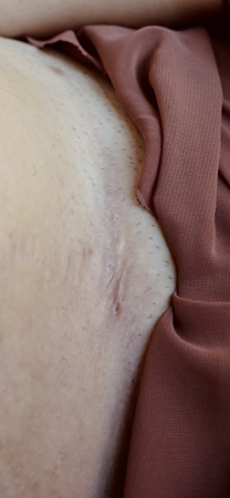 SBT Sorocaba - Entrevista: Vivendo com Hidradenite. thumbnail