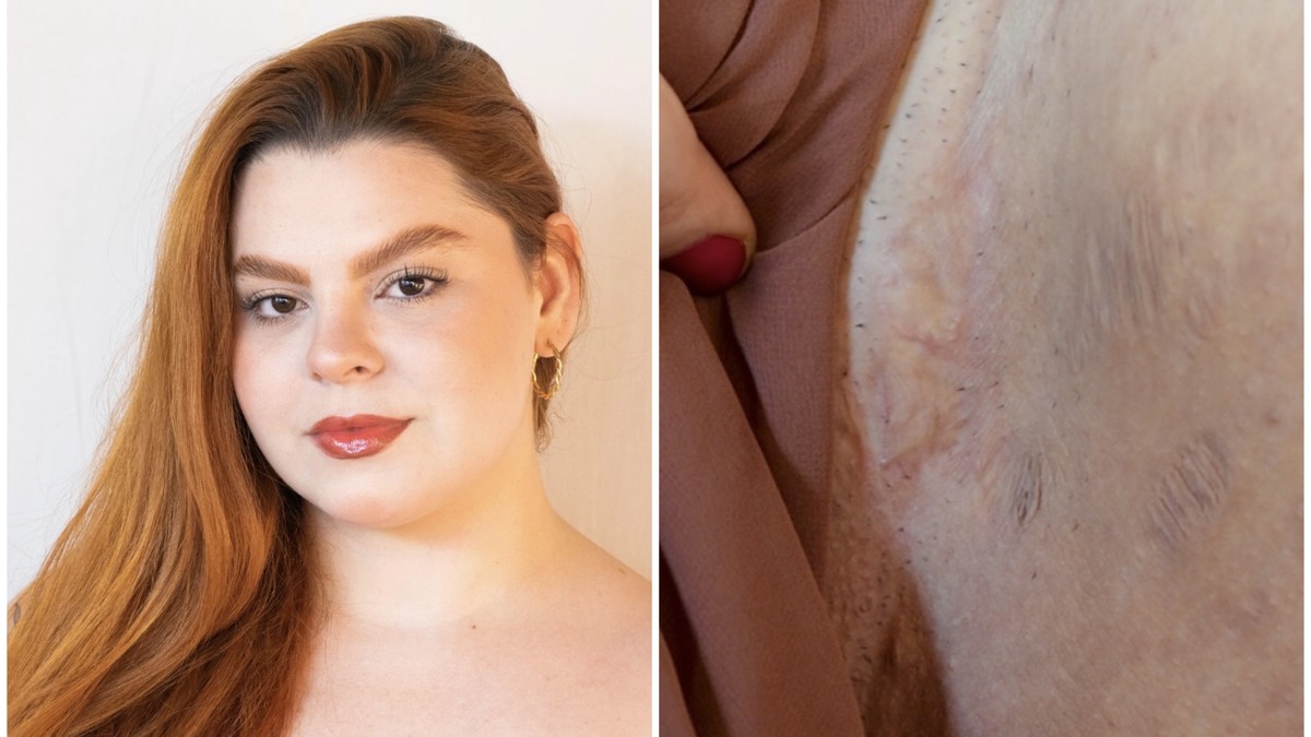 Revista MARIE CLAIRE - Autoestima&Hidradenite. thumbnail