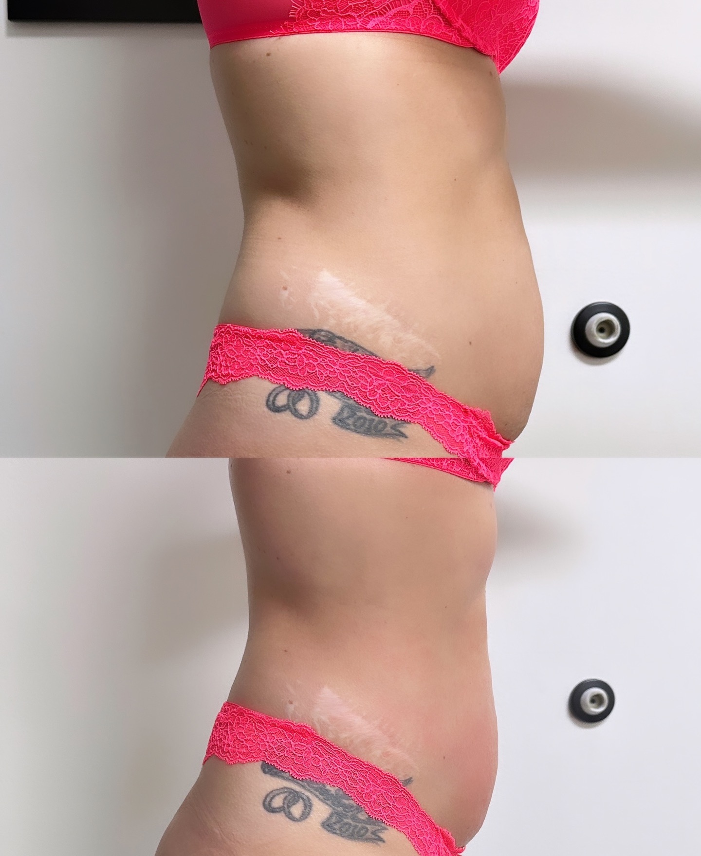 𝐍𝐨𝐧 𝐒𝐮𝐫𝐠𝐢𝐜𝐚𝐥 𝐋𝐢𝐩𝐨 🪄 

This was one session of 𝒶𝓁𝓂𝑜𝓈𝓉 magic ✨ 

Our Slim Waist session combines  Laser Lipolysis, Cavitat