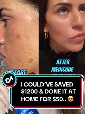$1200 SCAM vs. $40 MICRONEEDLING AT HOME..proof is in the pics! #microneedling #skincare #over40skincare #moms #momsofti