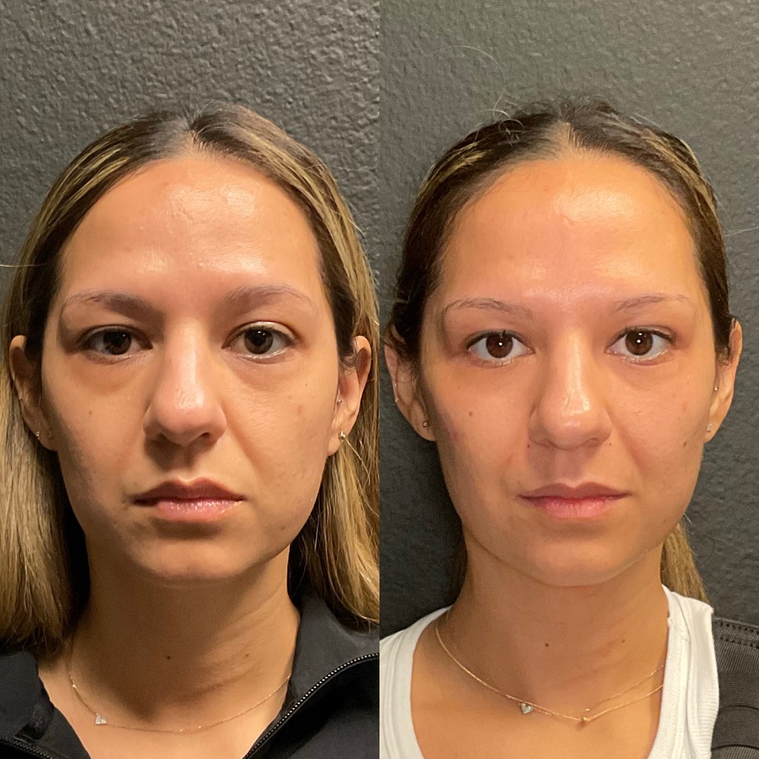 @ThePlasticInjector Instagram - Before & Afters thumbnail