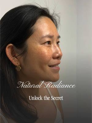 ✨ Before & After Botox Magic! ✨ Say goodbye to frown lines and hello to a smooth, refreshed look! This transformation is