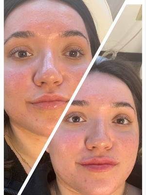 ✨ Subtle and stunning! This client opted for a half syringe of filler + a lip flip for a natural, enhanced pout 💋. Build