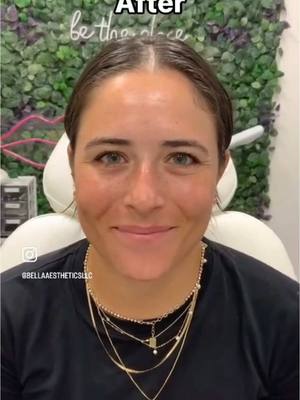 Empower your beauty journey with Xeomin! 🌿 Our wonderful client is taking the first step towards a smoother forehead. Wa