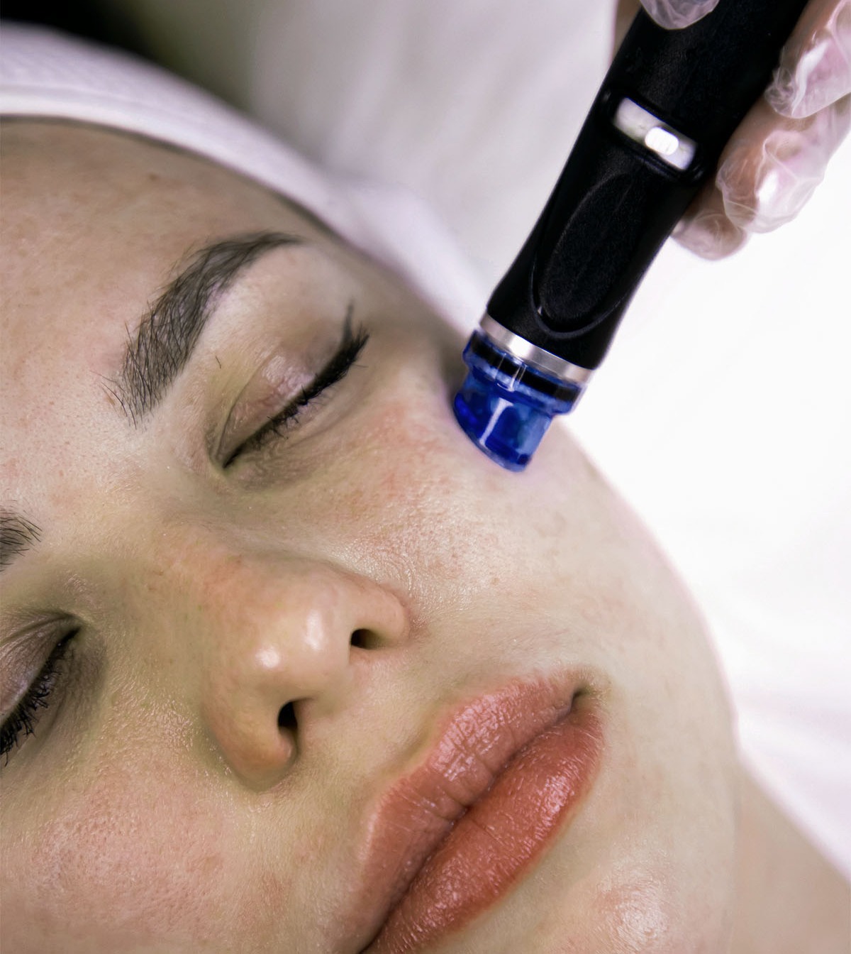 RF-Microneedling, Microneedling thumbnail