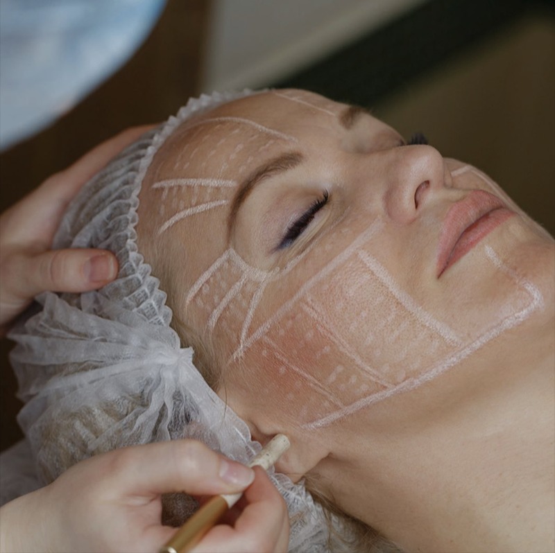 HIFU Therapy Full Face thumbnail