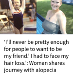 My Alopecia Story thumbnail