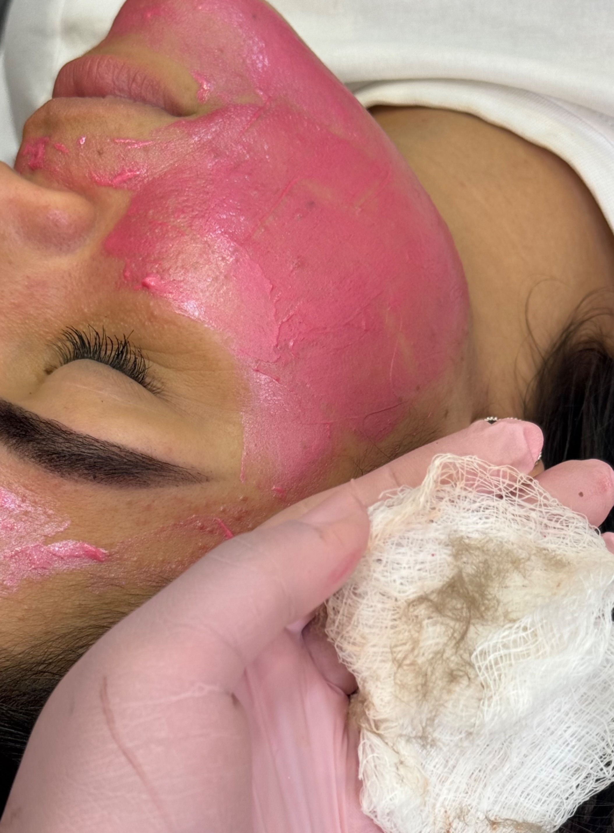 Dermaplaning thumbnail