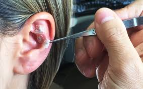 Auriculoterapia  thumbnail