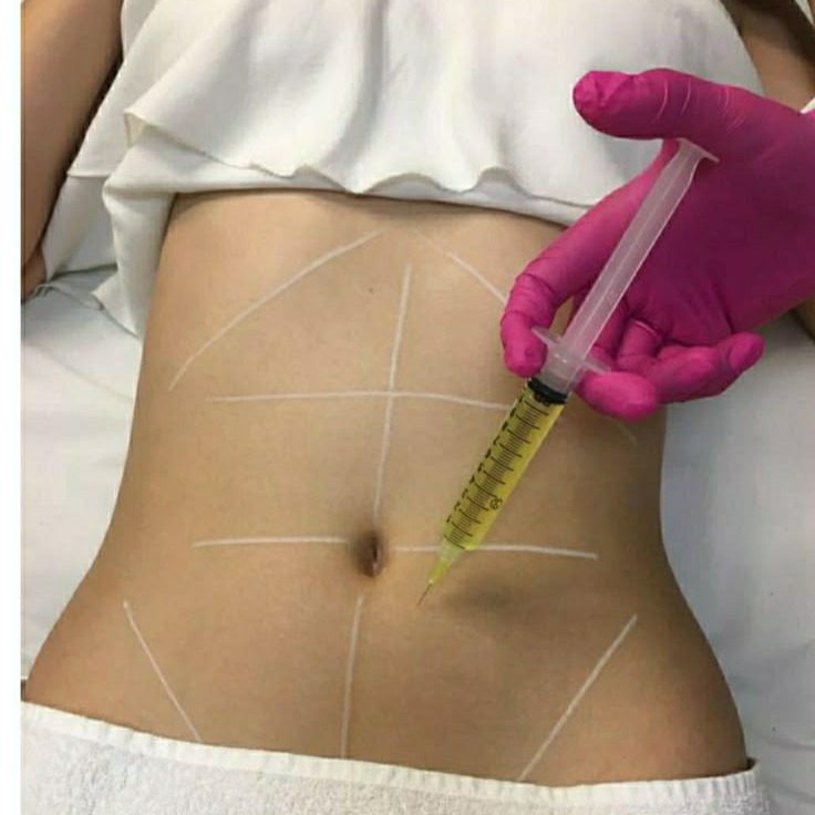 Intradermoterapia (gordura localizada, celulite, flacidez e papada) thumbnail