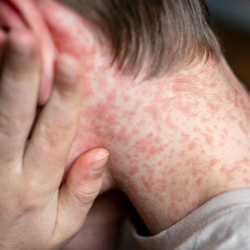 Torna il morbillo: rischio epidemia globale. La situazione in Italia thumbnail