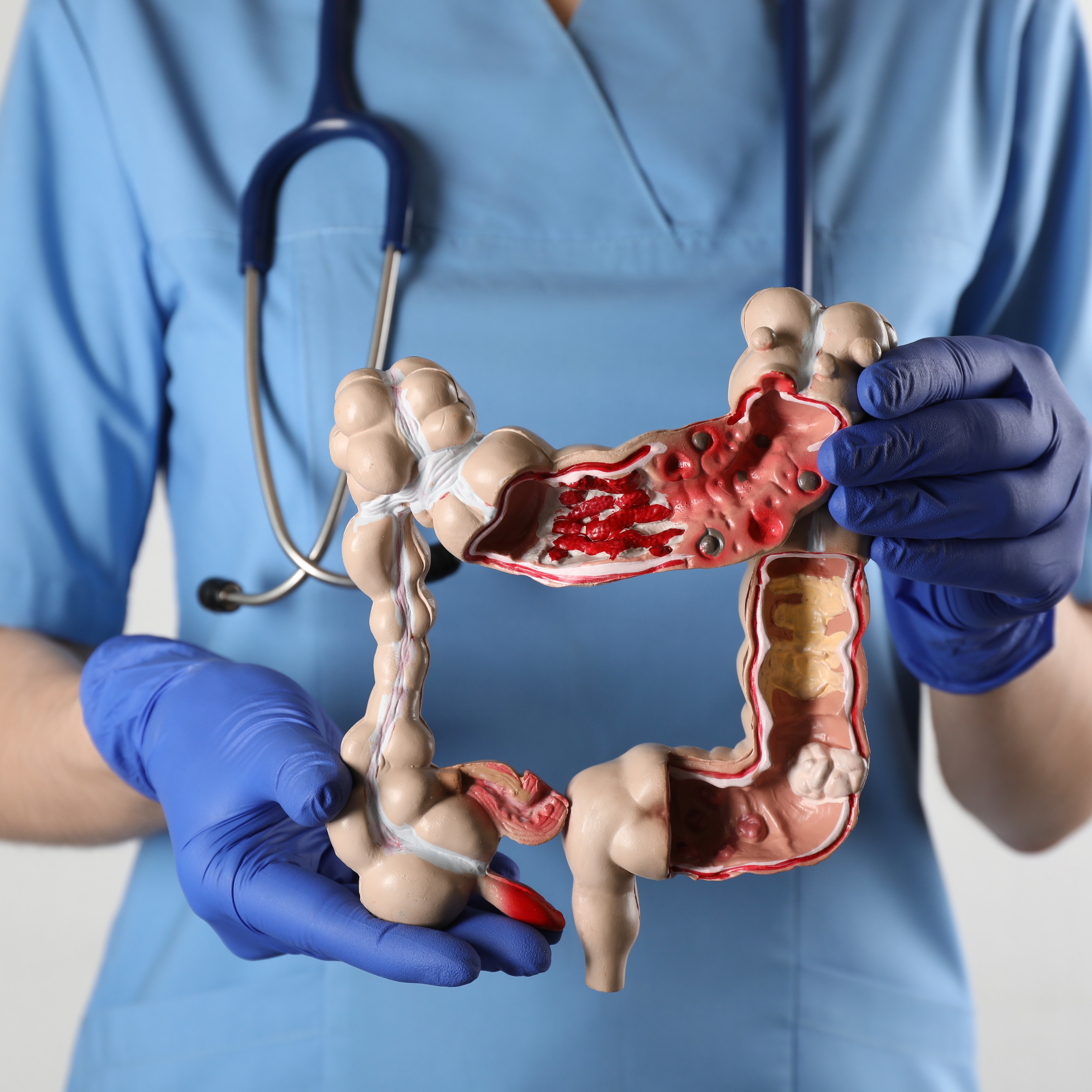 Tumore al colon, la guarigione completa è possibile. I risultati di un nuovo studio thumbnail