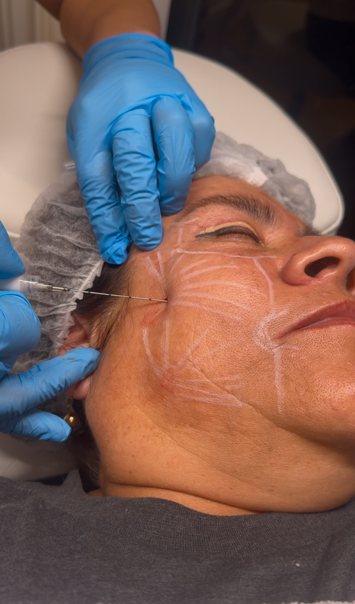 ARMONIZACION FACIAL / ACIDOHIALURONICO / RADIESSE BIOESTIMULACIÓN FACIAL. thumbnail