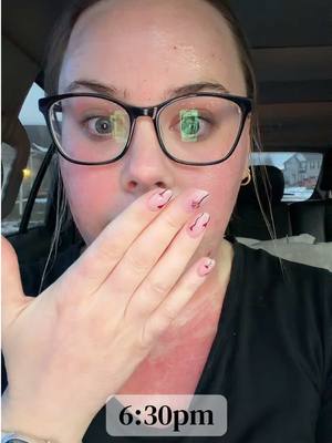 Morpheus8 treatment - my experience was great! The forehead, brow bone, upper lip, and throat area were the most tender 