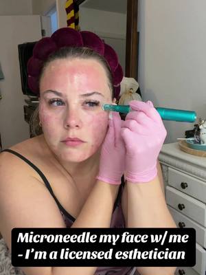 Idk what’s going on with my skin, but we’re going to fix it 🤗 #esthetician #microneedling #aesthetician #fyp #fypシ 