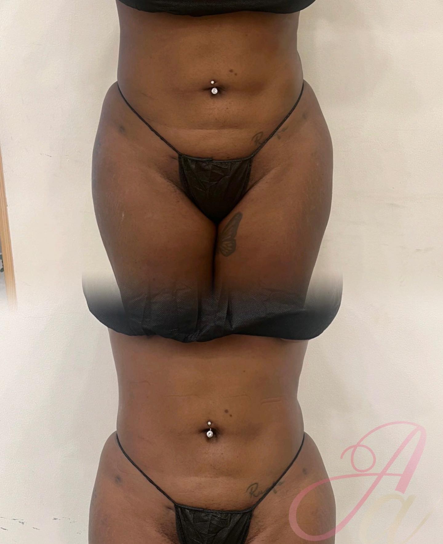 Swipe to see how we have snatched her stomach and waist to the Gods 😍🍑 what a difference 1 hour makes ⏰ 

Wood therapy i