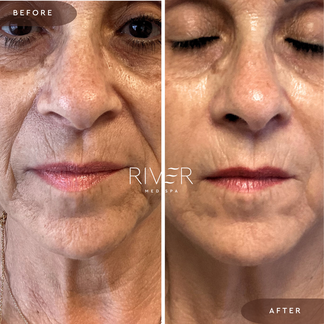 Schedule your RF-microneedling thumbnail