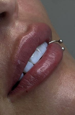 Preenchimento Labial | Agendamento thumbnail
