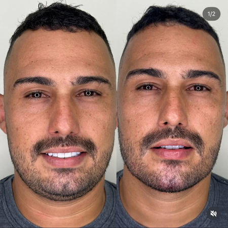 Harmonização Facial | Agendamento thumbnail