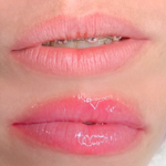 Hidralips  thumbnail