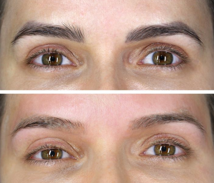 Despigmentação Química thumbnail