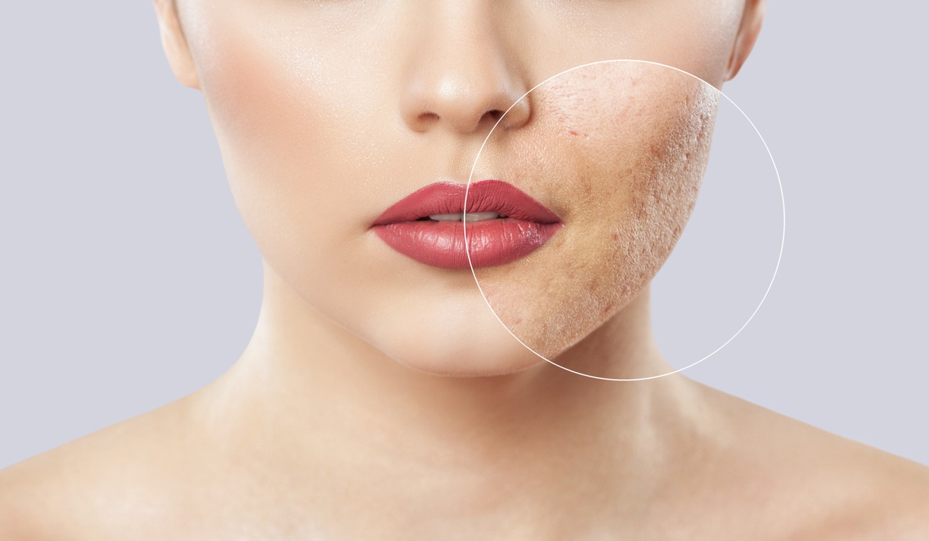 Tratamento para cicatriz de acne thumbnail