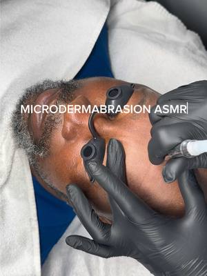 Microdermabrasion is a minimally invasive procedure used to renew overall skin tone and texture. It can help improve the