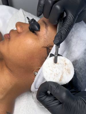 dermaplaning is a safe exfoliation procedure using a sterile surgical scalpel, removing 3 weeks of dead skin cells. INST