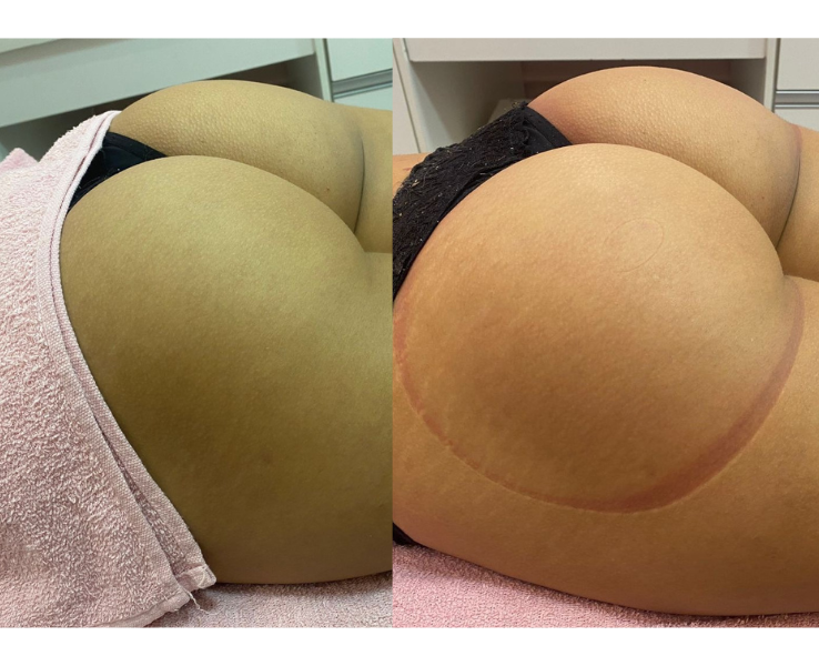 Remodelação de Glútea thumbnail