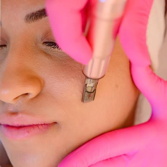 Rejuvenescimento Facial com Microagulhamento thumbnail