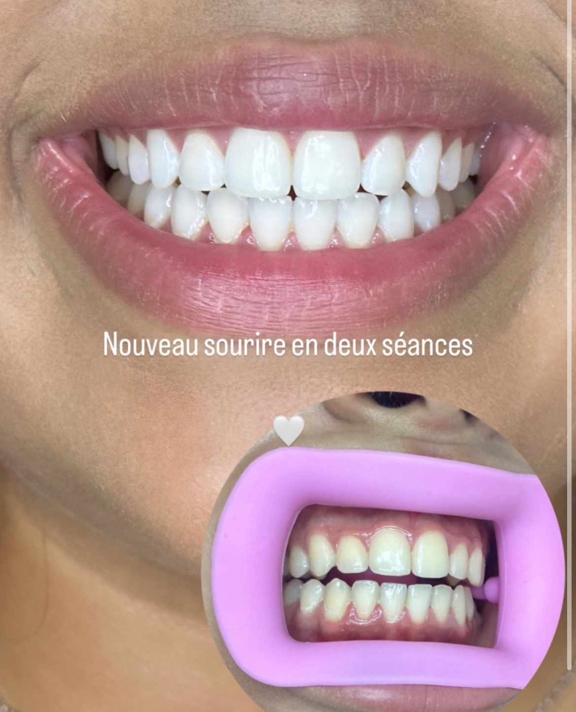 Blanchiment dentaire  thumbnail