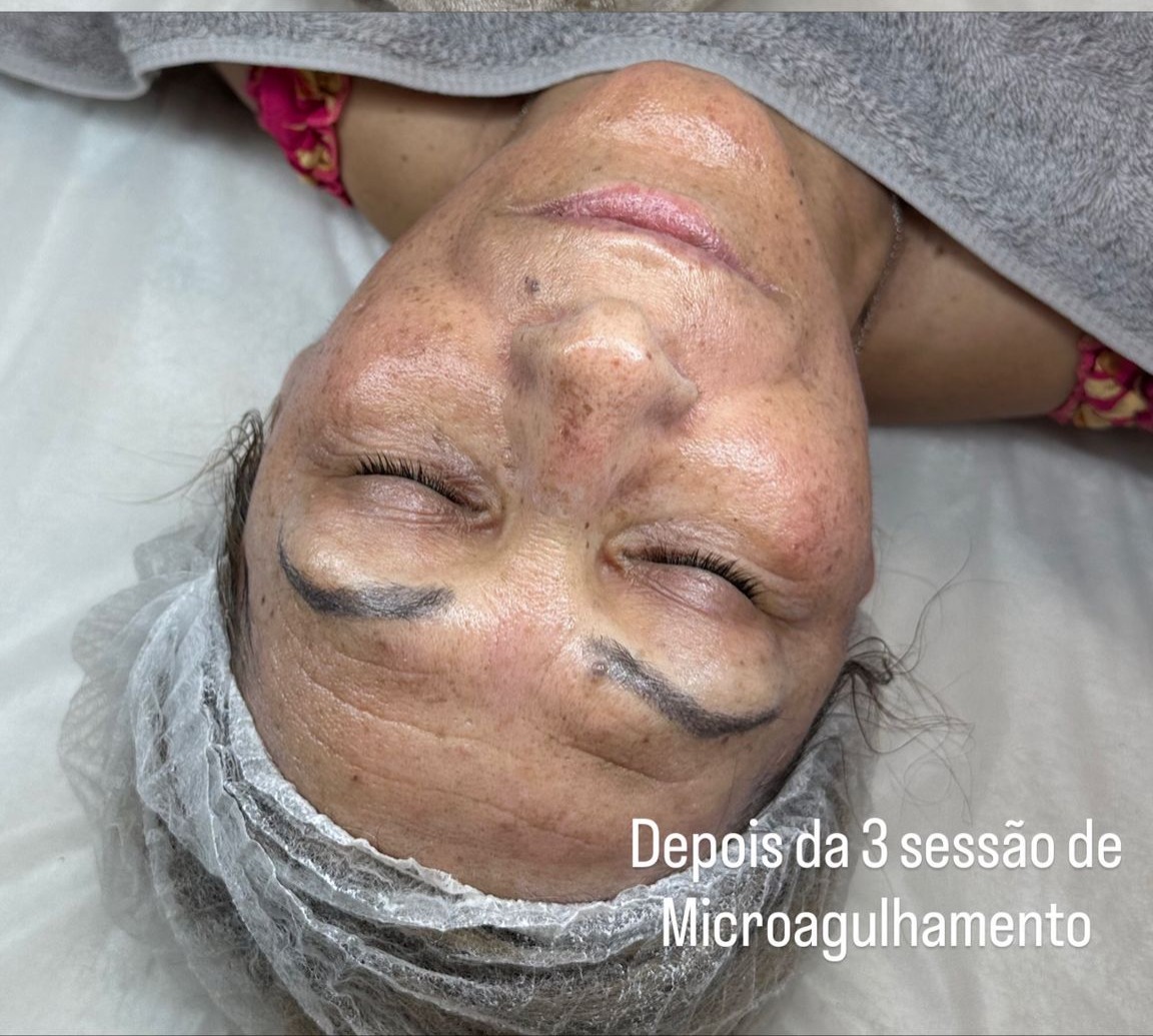 MICROAGULHAMENTO - 65€ POR SESSÃO thumbnail