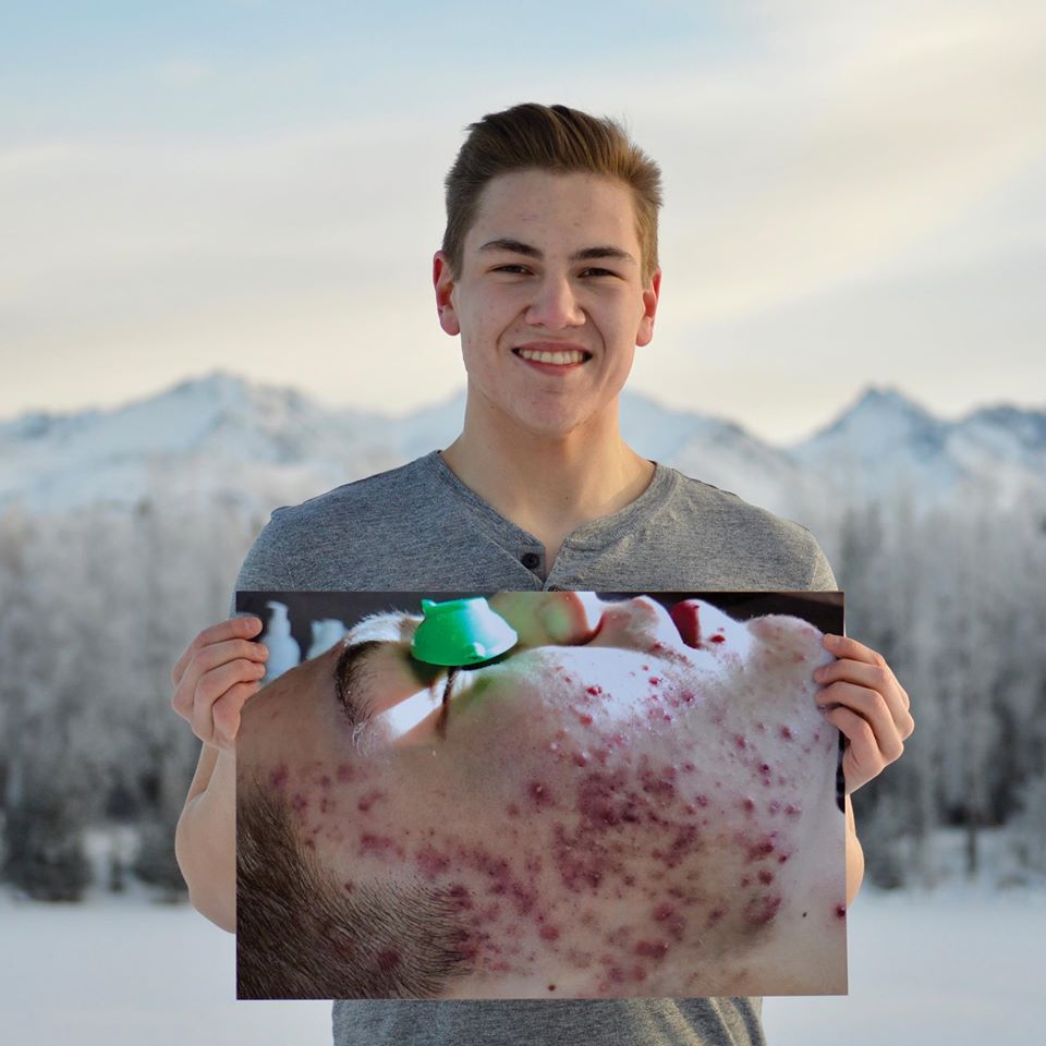 Acne Bootcamp  thumbnail