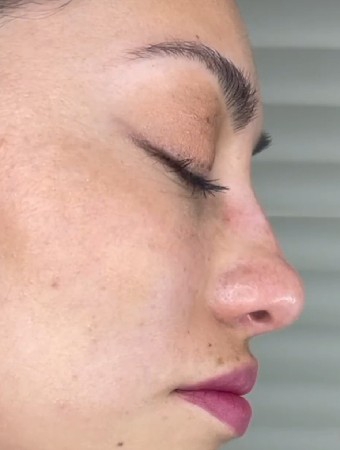 En segundos tenemos el cambio que tanto buscabas🤩💉🪄👏🏻
Un poquito de nuestra magia
Rinosculpt by Dr. Andres. thumbnail