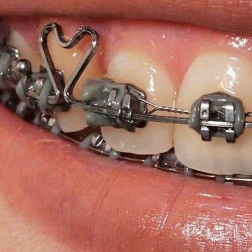 Κλασσική Ορθοδοντική thumbnail