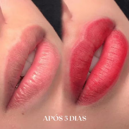 Kit Henna Labial Ate 40 Aplicagoes
Maquiagem Profissional Pode Usar Dermapen thumbnail