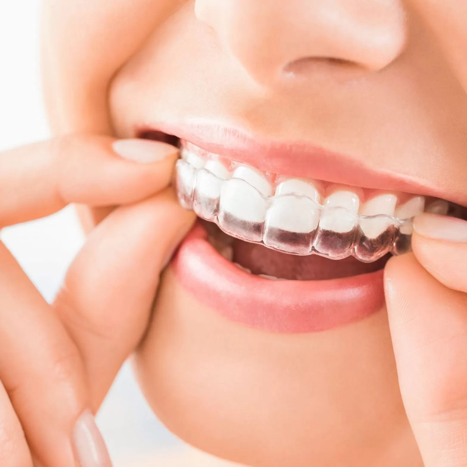 Invisalign thumbnail