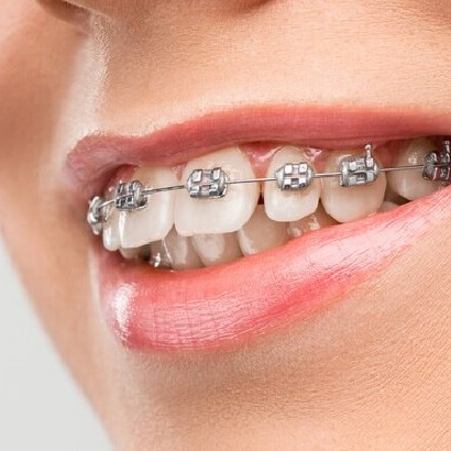 Aparelho Dental - Ortodontia thumbnail
