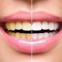 Clareamento Dental thumbnail