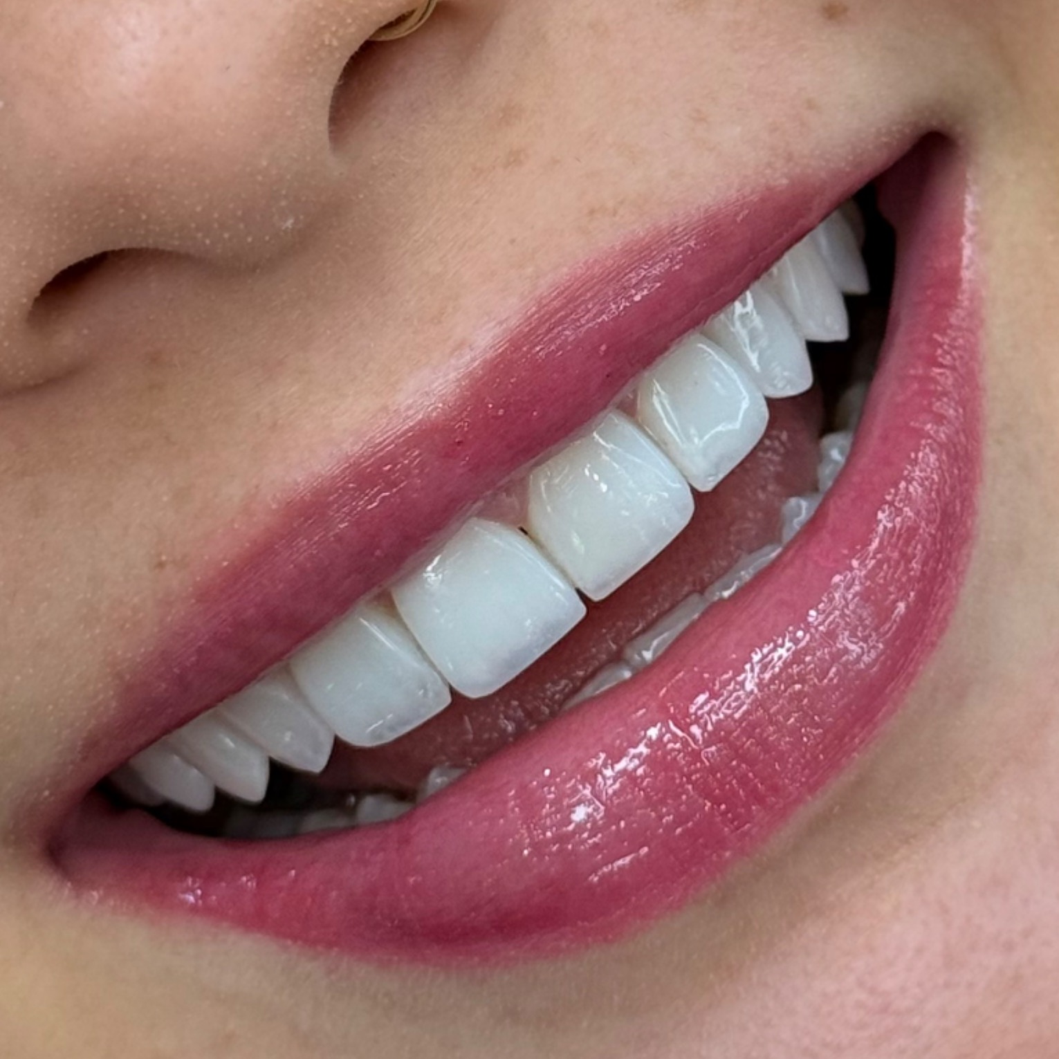 FACETAS EM RESINA  thumbnail