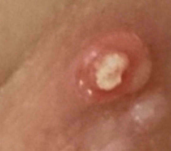 Best Treatments for Molluscum Contagiosum thumbnail