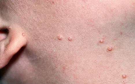 Does Molluscum Contagiosum Go Away on Its Own? thumbnail