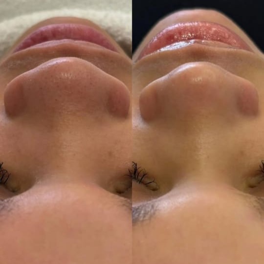 Limpeza de Pele Profunda Premium com Alta Frequência e Máscara de Ouro Rejuvenescedora - R$170 ⏱️ 80 Minutos thumbnail