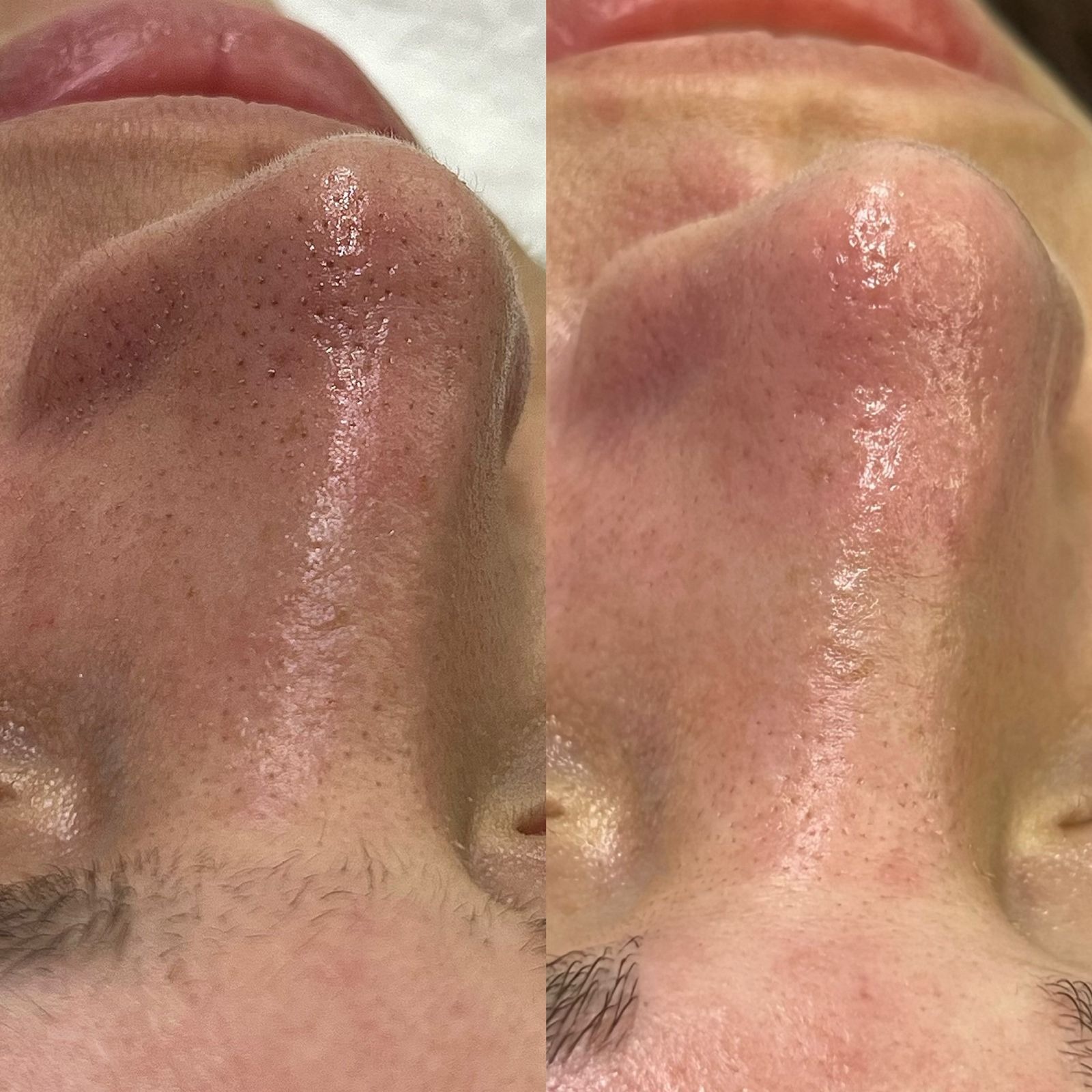 Limpeza de Pele Profunda - R$140 ⏱️ 60 Minutos thumbnail