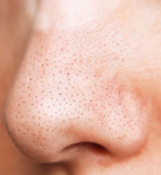 Protocolo Nariz de morango thumbnail