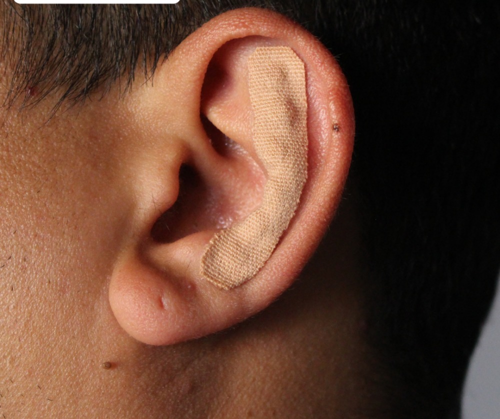 Bandagem auricular magnética. thumbnail