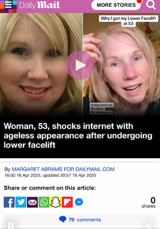 Article from Daily Mail about my Facelift Journey  thumbnail