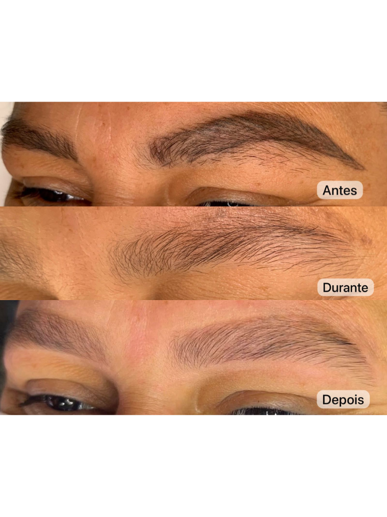 Despigmentação a Laser thumbnail