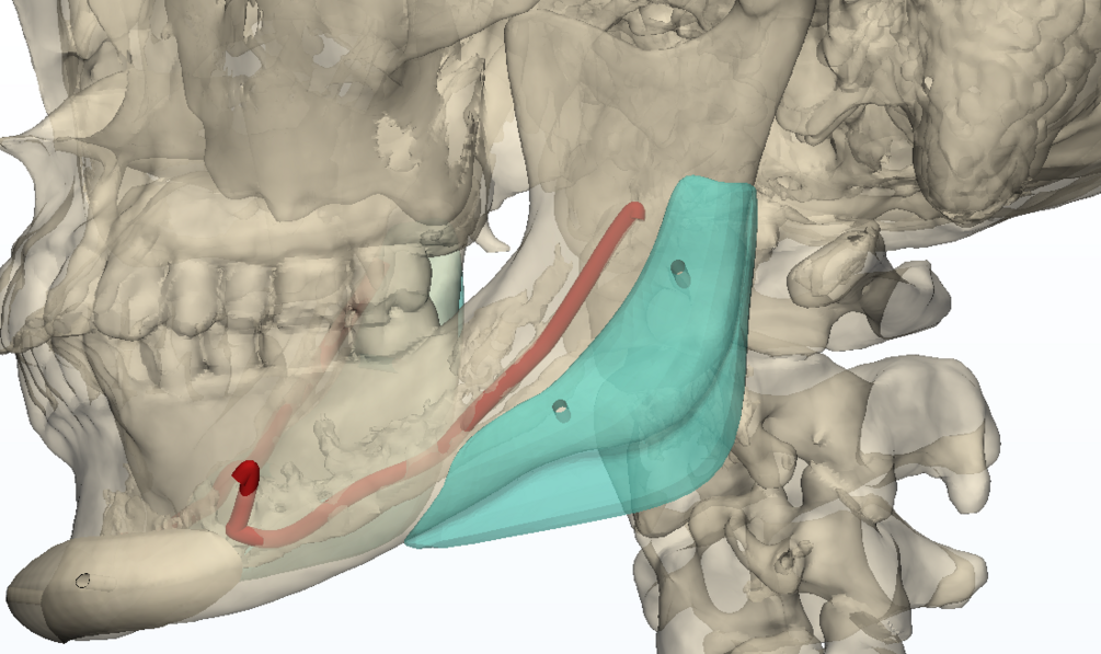 Servicio de Segmentación anatómica - Impresión 3d. thumbnail