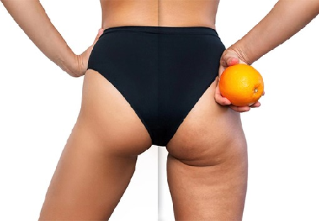 • cellulite reduction + Detox $389.99  》BOOK  packages of Five sessions  thumbnail
